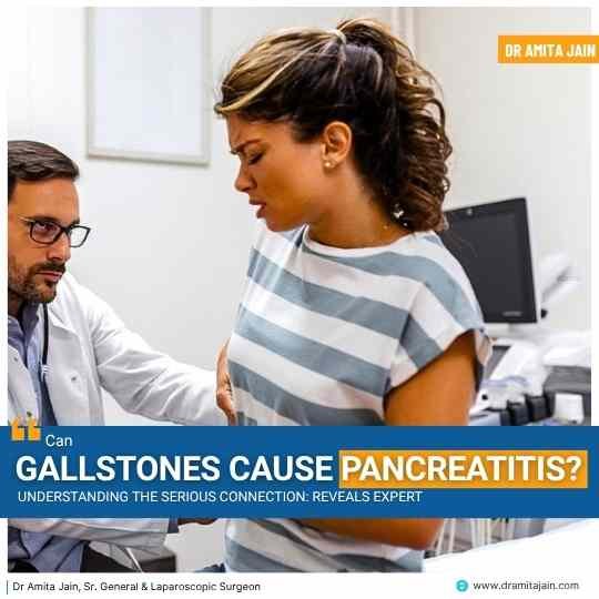 Can Gallstones Cause Pancreatitis? Understanding the Serious Connection: Reveals Expert