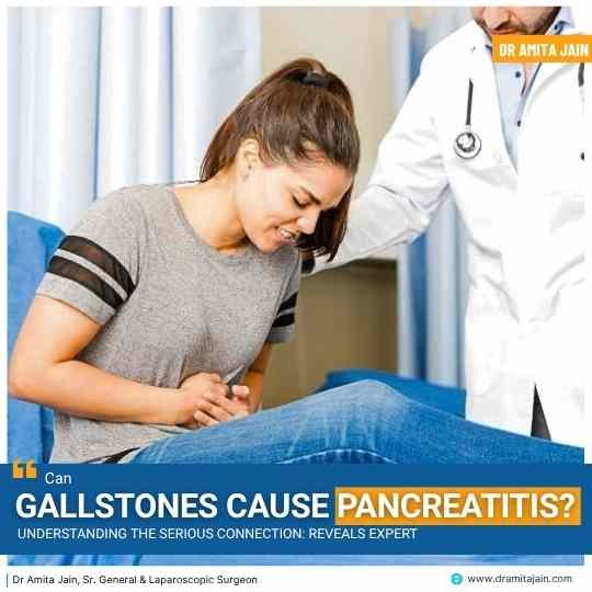 Can Gallstones Cause Pancreatitis? Understanding the Serious Connection: Reveals Expert