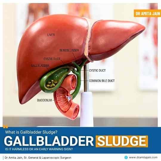 What Is Gallbladder Sludge: Is It Harmless or an Early Warning Sign?