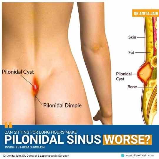 Pilonidal Sinus treatment and surgery by Dr Amita Jain