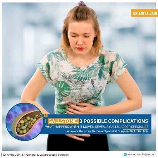gallstone removal surgery insight by Dr Amita Jain